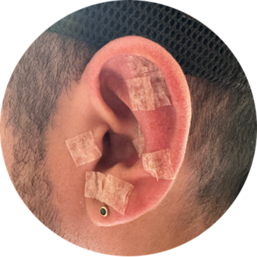 Auriculoterapia